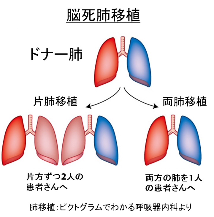 脳死肺移植(両肺移植と片肺移植)