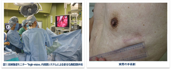 高解像度モニター、実際の手術創