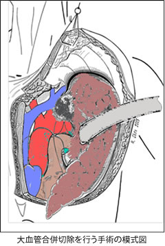 大血管合併切除を行う手術の模式図