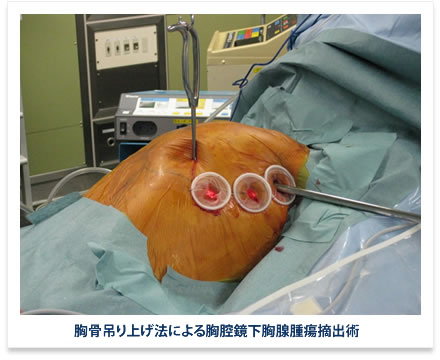 胸骨吊り上げ法による胸腔鏡下胸腺腫瘍摘出術