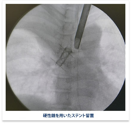 硬性鏡を用いたステント留置