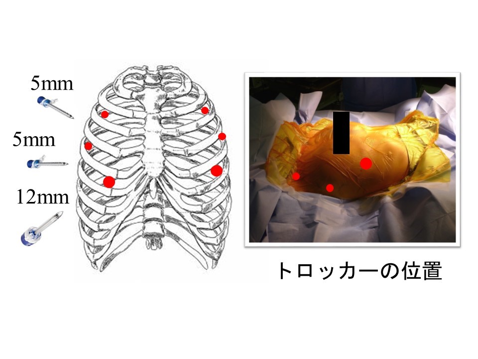 胸腔鏡アプローチによる拡大胸腺摘出術、ロボット支援手術
