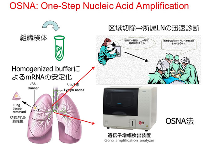 OSNA:One-Step Nucleic Acid Amplification